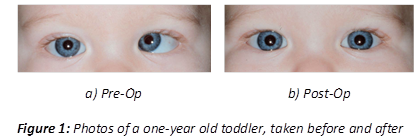 	 
a) Pre-Op	b) Post-Op
Figure 1: Photos of a one-year old toddler, taken before and after surgery for strabismus


