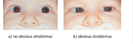 a) no obvious strabismus	b) obvious strabismus
Figure 2:  Consecutive photos of a six-week-old strabismic infant