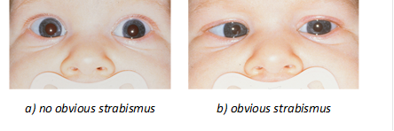  	 
a) no obvious strabismus	b) obvious strabismus
Figure 2:  Consecutive photos of a six-week-old strabismic infant 
